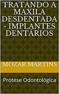 Livro Tratando a Maxila Desdentada - Implantes Dentários: Prótese Odontológica